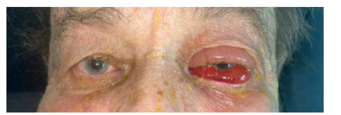 Severe Ocular Adverse Reaction Following Single Pembrolizumab Infusion: A Case Report