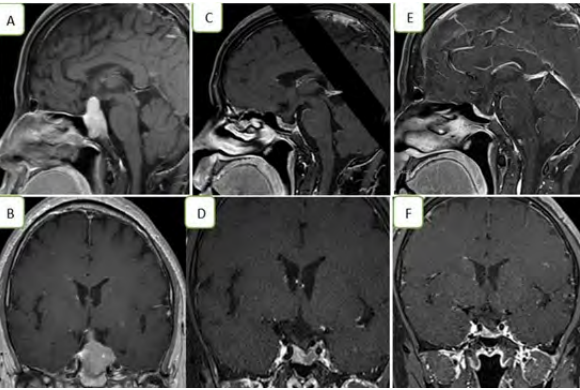 The High-Dose Dopamine Agonist Treatment Induced Pituitary Apoplexy: A Case Report