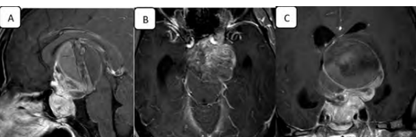 Diagnosis and Management of Male Prolactinoma: Similarities and Differences