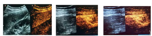 Splenic Hamartoma: A Case Series