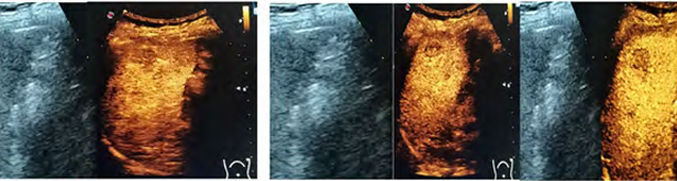 Splenic Hamartoma and Contrast Enhanced Ultrasound pattern: a Case Series