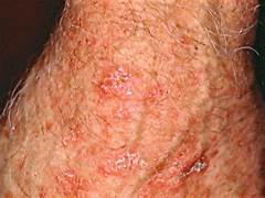 Skin Tumors