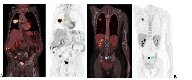 A prospective pilot analysis of Correlation of F-18 FDG PET/CT Radiomics with Tumor Mutations from Cell free DNA in Lung Cancer Patients