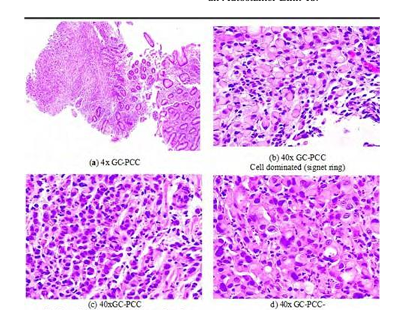 Low Cohesive Gastric Cancer of the Antrum and Duodenum. Multi-omics analysis Can it Improve Treatment?