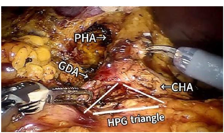 Clinical Value of Robot-Assisted Pancreaticoduodenectomy in the Treatment of Locally Advanced Pancreatic Head Cancer