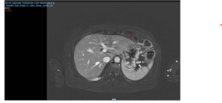 Immunotherapy in Metastatic Pancreatic Adenocarcinoma with DNA Repair Deficiency: ANarrative Review of Current Evidence and Therapeutic Perspectives