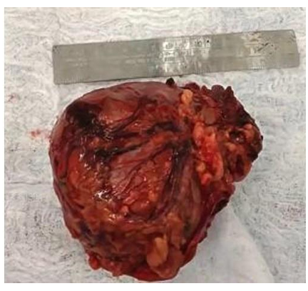 Oncocytic Adrenocortical Carcinoma: Case Report from a Level IV Clinic in Cali-Colombia